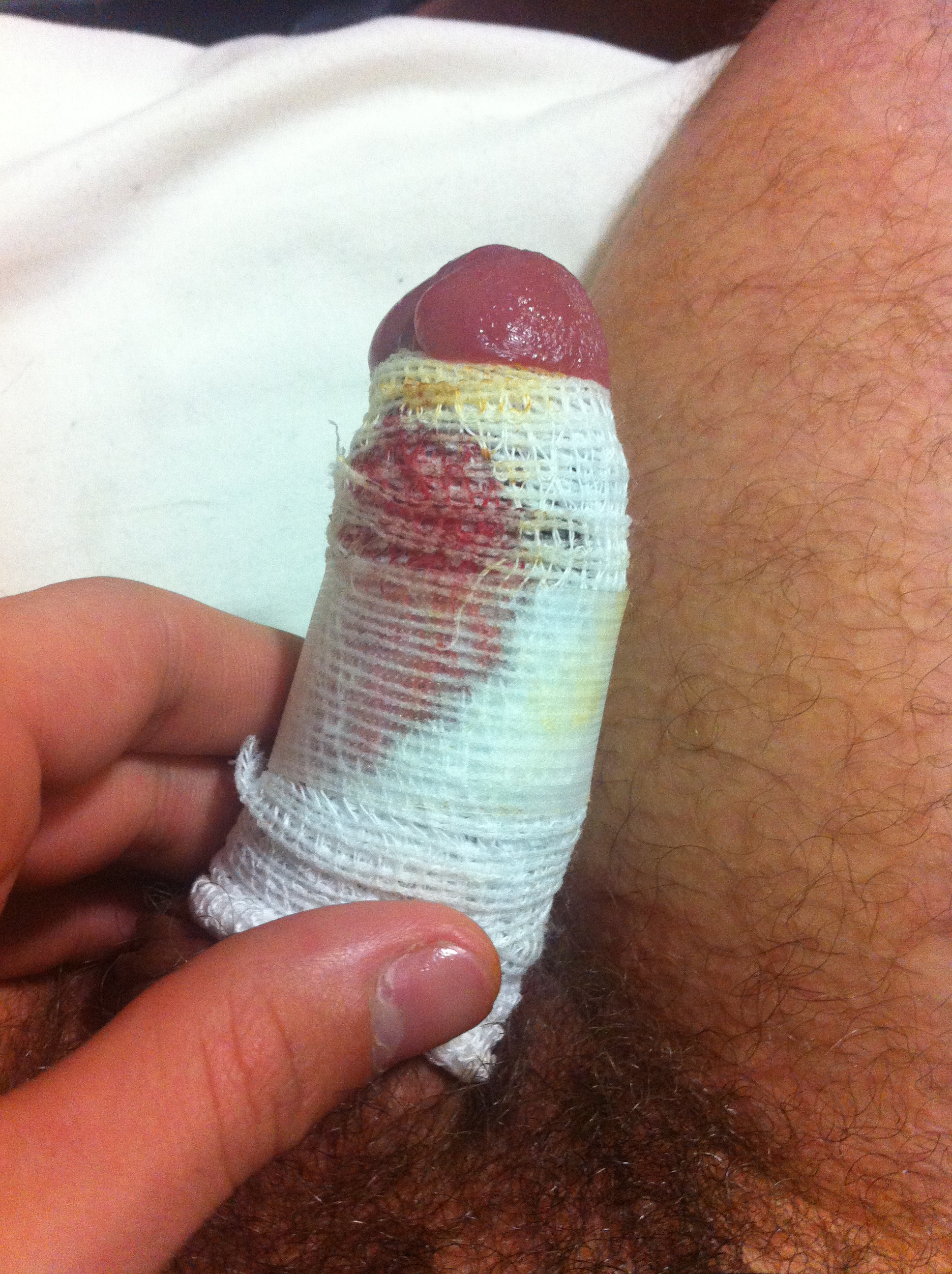 Side view of my circumcised penis with dressing. 